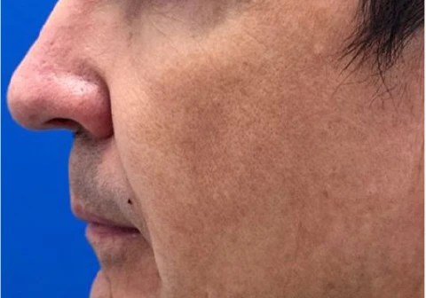 After RENOPHASE protocol, 5 months