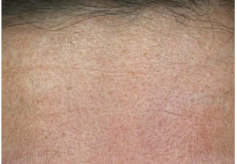 After RENOPHASE protocol, 2 months