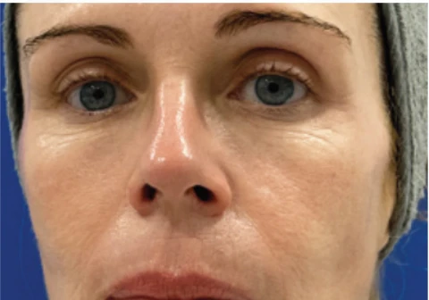 After RENOPHASE protocol, 6 weeks