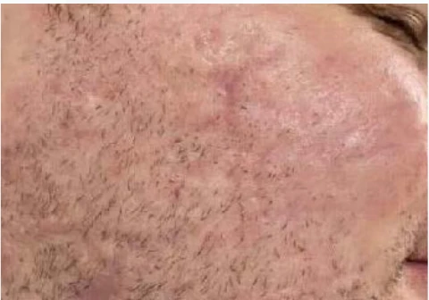 After RENOPHASE protocol, 5 weeks