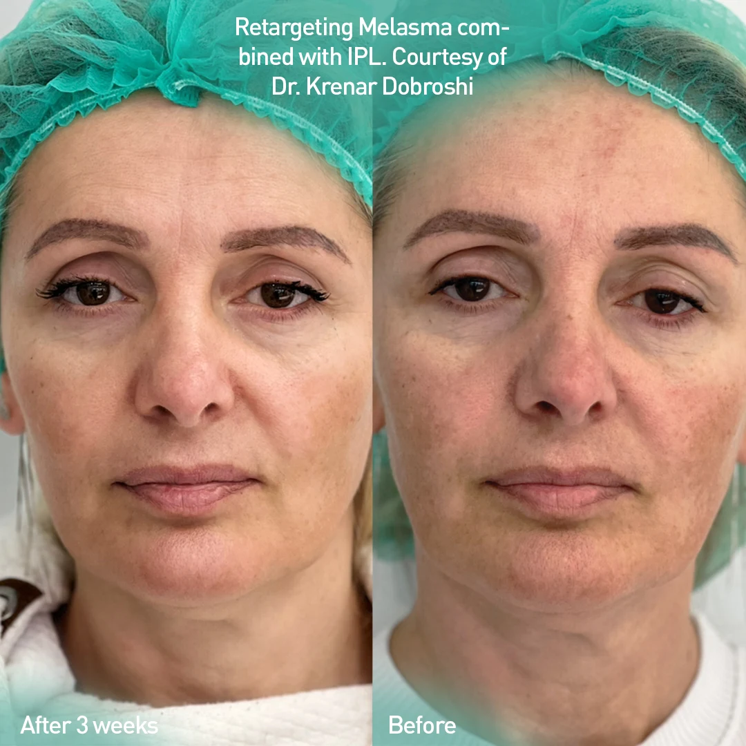 Melasma protocol combined with IPL, before and after 3 weeks