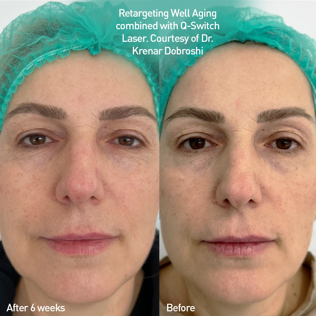 Rejuvenation protocol, before and after 6 weeks
